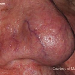 IPL for Veins Before & After Patient #10325