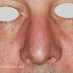 IPL for Veins Before & After Patient #10326