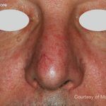 IPL for Veins Before & After Patient #10326