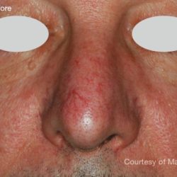 IPL for Veins Before & After Patient #10326