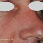 IPL for Veins Before & After Patient #10327