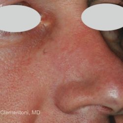 IPL for Veins Before & After Patient #10327