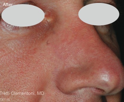 IPL for Veins Before & After Patient #10327