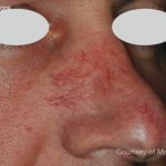 IPL for Veins Before & After Patient #10327