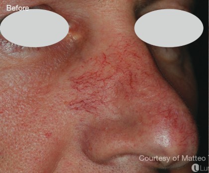 IPL for Veins Before & After Patient #10327