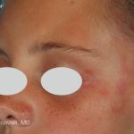 IPL Port Wine Stain Before & After Patient #10339