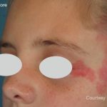 IPL Port Wine Stain Before & After Patient #10339