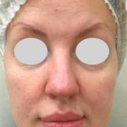 IPL Rosacea Before & After Patient #10342