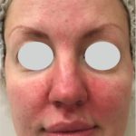 IPL Rosacea Before & After Patient #10342