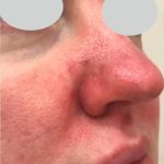 IPL Rosacea Before & After Patient #10342