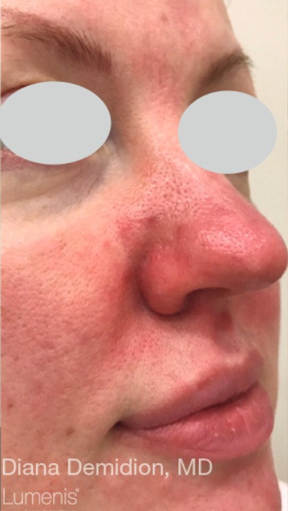 IPL Rosacea Before & After Patient #10342