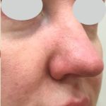 IPL Rosacea Before & After Patient #10342