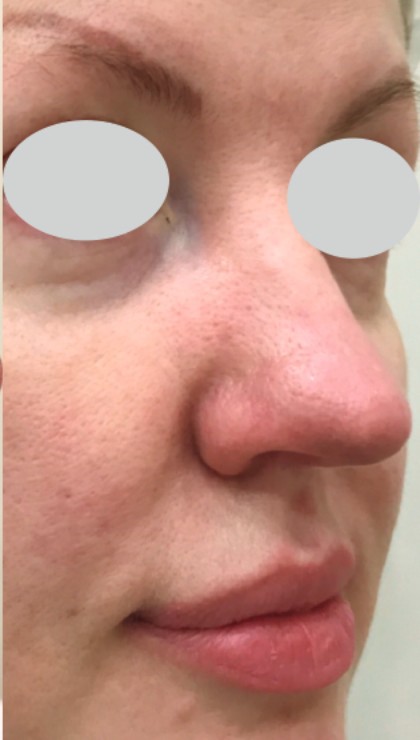 IPL Rosacea Before & After Patient #10342