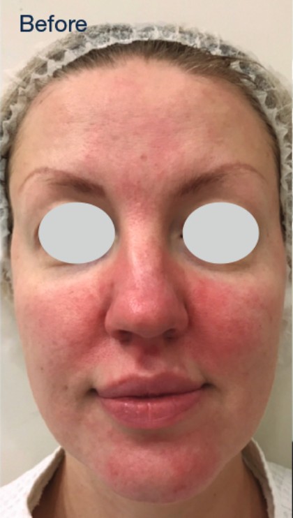 IPL Rosacea Before & After Patient #10342