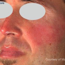 IPL Rosacea Before & After Patient #10343