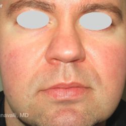 IPL Rosacea Before & After Patient #10344