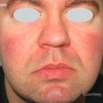IPL Rosacea Before & After Patient #10344
