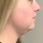 Neck Liposuction Before & After Patient #10389