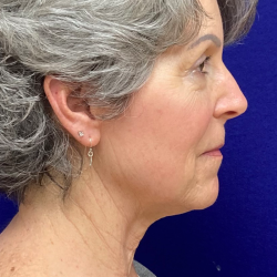 HourLift Before & After Patient #10379