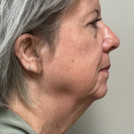 Mini Facelift Before & After Patient #10395