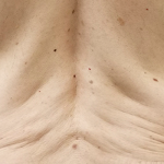 Morpheus8 Before & After Patient #10424