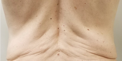 Morpheus8 Before & After Patient #10424