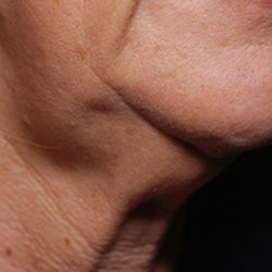 Morpheus8 Before & After Patient #10427