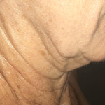 Morpheus8 Before & After Patient #10430