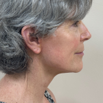 HourLift Before & After Patient #10379
