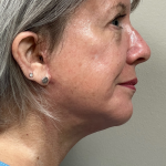 Mini Facelift Before & After Patient #10395