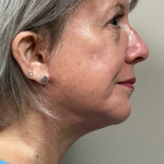 HourLift Before & After Patient #10395