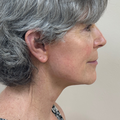 HourLift Before & After Patient #10379