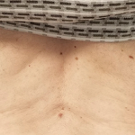 Morpheus8 Before & After Patient #10424