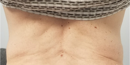 Morpheus8 Before & After Patient #10424