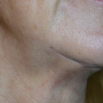 Morpheus8 Before & After Patient #10427