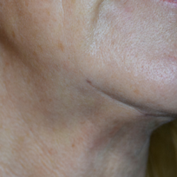 Morpheus8 Before & After Patient #10427