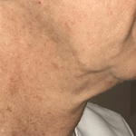 Morpheus8 Before & After Patient #10430