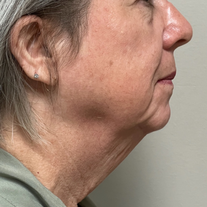 Neck Liposuction Before & After Patient #10400