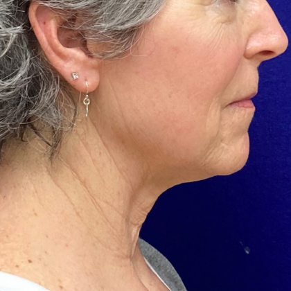 Neck Lift Before & After Patient #10385