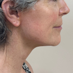 Neck Lift Before & After Patient #10385