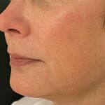 Ellacore Micro-Coring Before & After Patient #10403