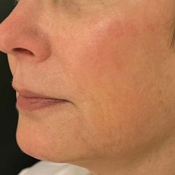 Ellacore Micro-Coring Before & After Patient #10403