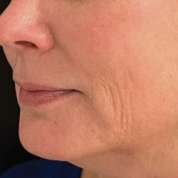 Ellacore Micro-Coring Before & After Patient #10403