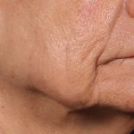 Ellacore Micro-Coring Before & After Patient #10406