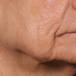 Ellacore Micro-Coring Before & After Patient #10406