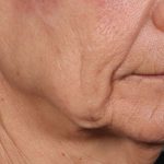 Ellacore Micro-Coring Before & After Patient #10406