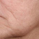 Ellacore Micro-Coring Before & After Patient #10410