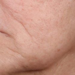 Ellacore Micro-Coring Before & After Patient #10410