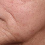Ellacore Micro-Coring Before & After Patient #10410
