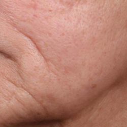 Ellacore Micro-Coring Before & After Patient #10410